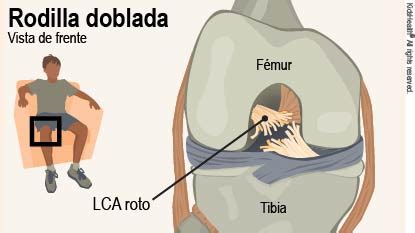 Desgarros Del Ligamento Cruzado Anterior