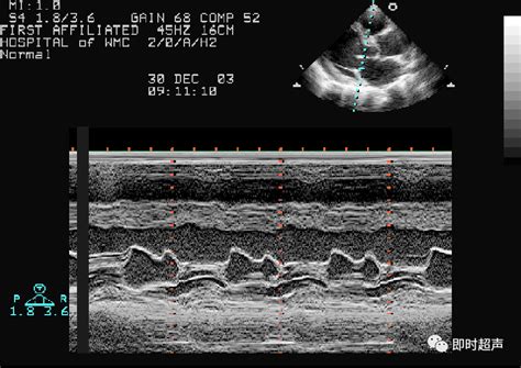 心脏瓣膜病超声诊断二尖瓣