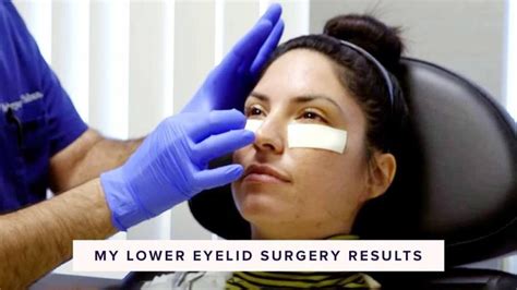 7 Day Lower Blepharoplasty Recovery Daily Photo Progress Actualizado