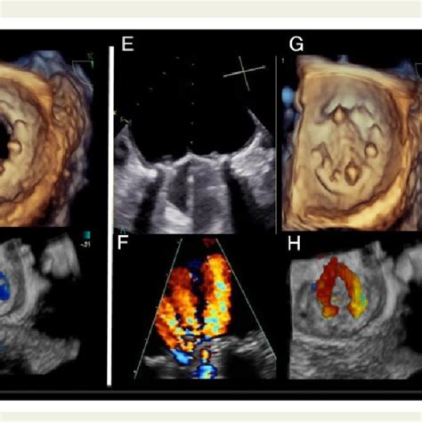 Mitral Prosthesis Eoa Calculation Using The Continuity Equation The