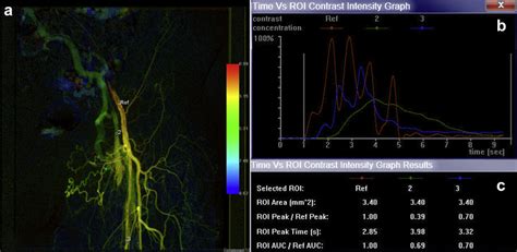 A Color Coded Map Of Angiography Performed After Balloon Angioplasty