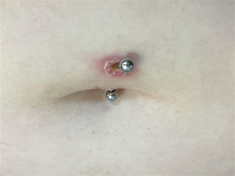 Possible Infected Belly Piercing R Piercing