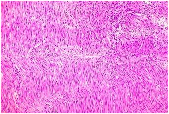 Cellular Leiomyoma With Increased Cellularity Without Nuclear Atypia