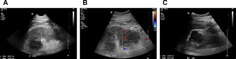 Ultrasound Of Renal Masses Radiologic Clinics