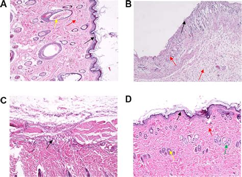 Pathological Section Analysis Of Inflammatory Tissue Around The