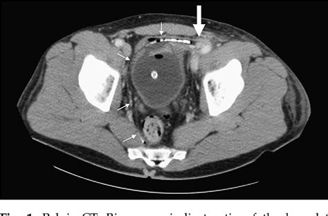 Figure 1 From Abberant Sex Habits Leading To Acute Limb Ischemia And Hematuria Semantic Scholar