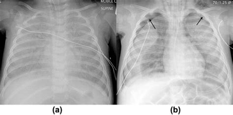 Pulmonary Complications In The Non Hiv Immunocompromised Patient Clinical Radiology