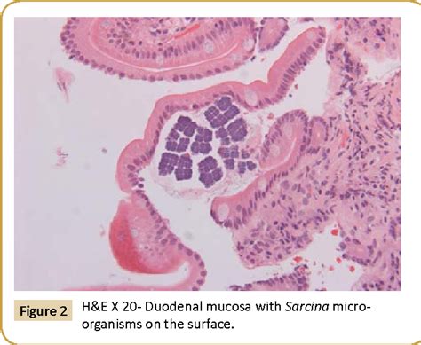 Figure From Sarcina Ventriculi Bacteria In Stomach And Duodenum Of A