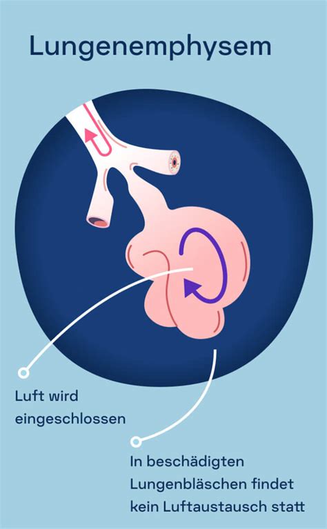 COPD Ursachen Behandlung Und Symptome Kaia Health