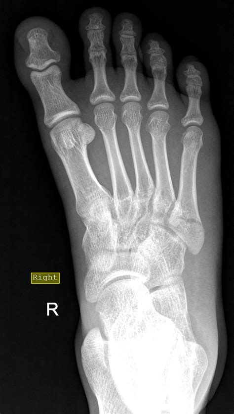 Fifth Metatarsal Base Fracture Jones Fracture Image