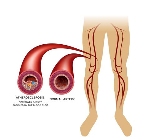 Peripheral Artery Disease Vivid Vascular Serving Miami And All Of