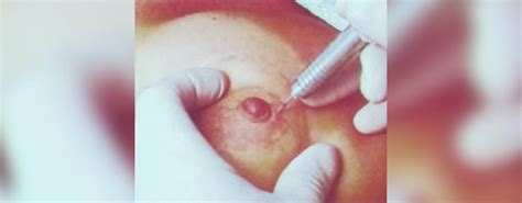 Nipple Areola Complex Reconstruction Surgery Nipple Sparing