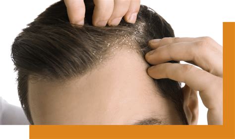 Scalp Corrective Treatment Hair Loss Treatment