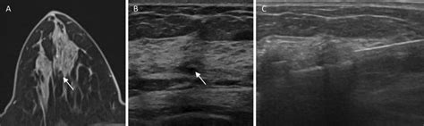 Mri And Ultrasound Findings During The Vacuum Assisted Biopsy Procedure