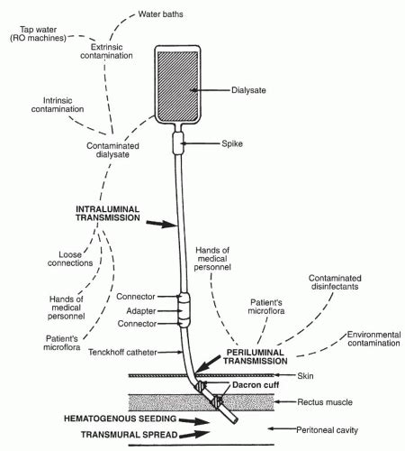 Infections Associated With Peritoneal Dialysis | Basicmedical Key