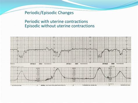 Ppt Fetal Monitoring Basics Expanded Powerpoint Presentation Free Download Id1901924