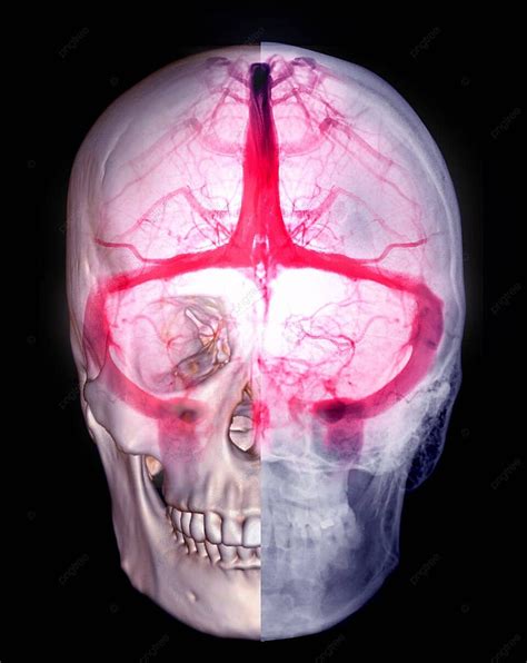 Cerebral Venous Thrombosis Diagnosis Through Cerebral Venography