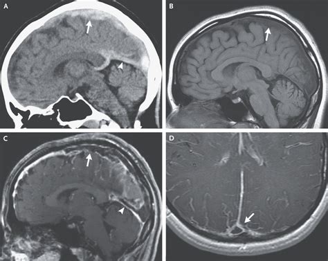 Cavernous Sinus Thrombosis Mrv