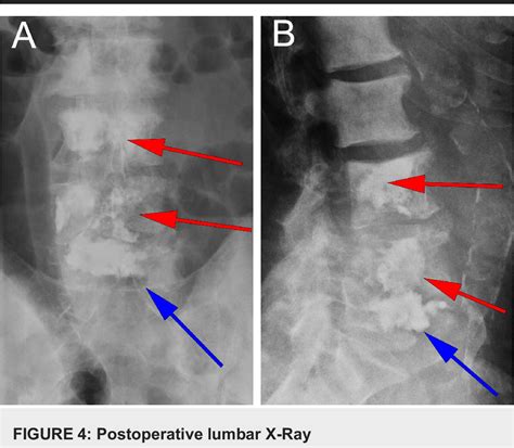 Figure 4 From Stereotactic Vertebroplasty For Spinal Metastases With