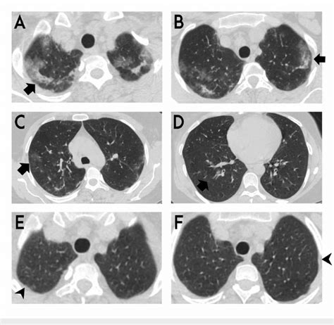 Thorax Ct Sections Of The Patient A D Bilateral Ground Glass Download Scientific Diagram