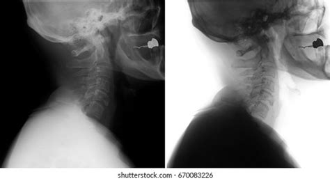 Xray Cspine Fracture Cervical Vertebra Spinous Stock Photo 670083226 | Shutterstock