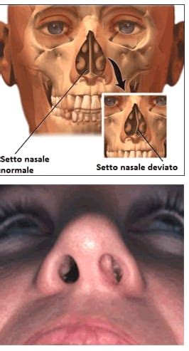 Setto Nasale Deviato