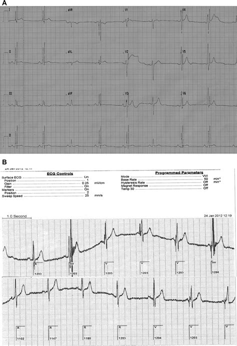 E A Surface Ecg Showing Two Pacing Spikes Except Third And Sixth