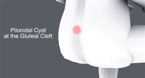 Pilonidal Disease Treatment Cyst Surgery Los Angeles Dr Kamrava