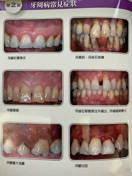 牙周病是什麼10個常見牙周病症狀及早治療擺脫口腔問題