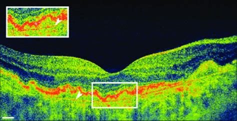 High Speed Ultrahigh Resolution Oct Image Of The Left Eye Shows