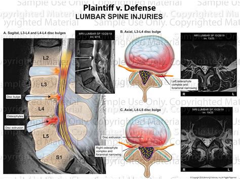 Disc Bulges Stenosis L3 4 And L4 5 Motionlit