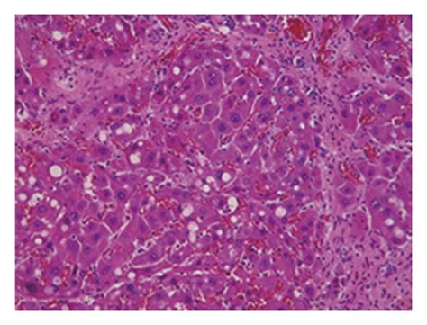 Ce Ameliorates Hepatic Fibrosis In Rats With Ccl Induced Liver Damage