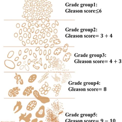 Newly Modified Gleason Grading Diagram Presented In The ISUP