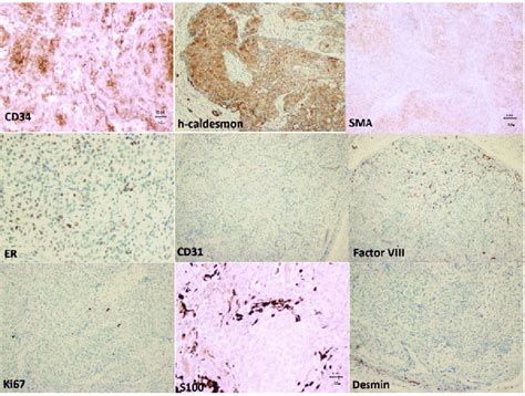 The Tumor Is Diffusely Positive For Cd And H Caldesmon Faintly