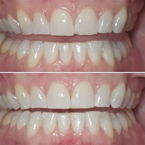 Smile Gallery - Before & After Photos | Coolidge Corner Dental