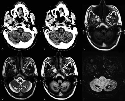 Cerebellar Parenchymal Abnormalities In The Patient A And B Axial