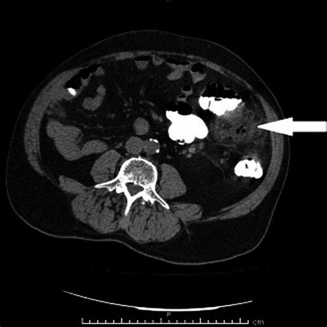 Intracorporeal stapled anisoperistaltic ileosigmoid anastomosis ...