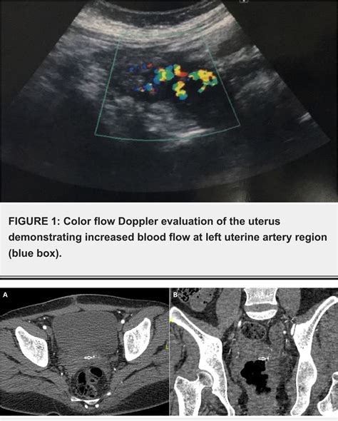 Figure 1 From Role Of Uterine Artery Embolization In Pseudoaneurysm Of