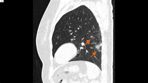 COVID-19 pneumonia – Chest X-ray or CT? - Siemens Healthineers