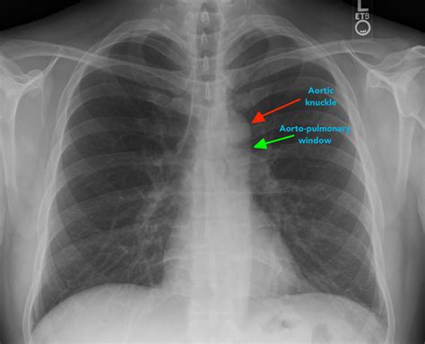 Neat How To Report Normal Chest X Ray Write A Good Introduction For