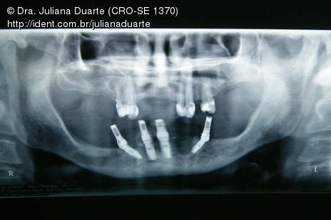 Protocolo Inferior Exodontias E Carga Imediata Caso Cl Nico Ident