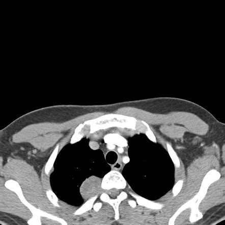 Multiple Schwannomas Image Radiopaedia Org