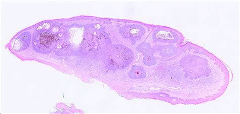 Histopathology Of Polypoid Basal Cell Carcinoma Note The Infiltrative