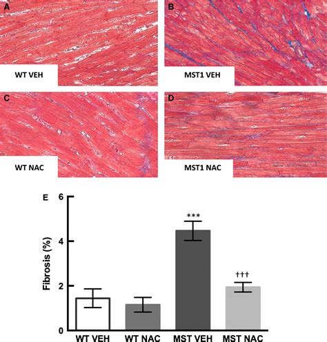 Nacetylcysteine Attenuates The Development Of Cardiac Fibrosis And