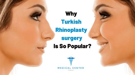 Why Turkish Rhinoplasty Surgery Is So Popular Mct