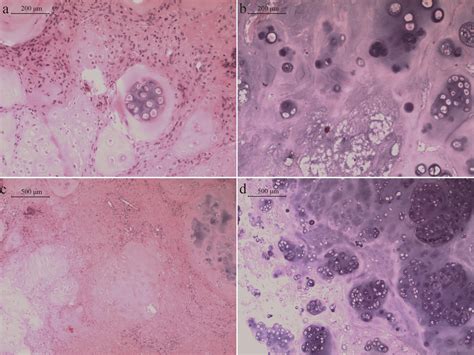 Arthroscopic Treatment Of Atypical Synovial Osteochondromatosis Of