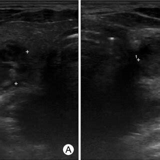 Thyroid US shows 1.3×1.1×2.2 cm sized thyroid nodule with hypoechoic ...