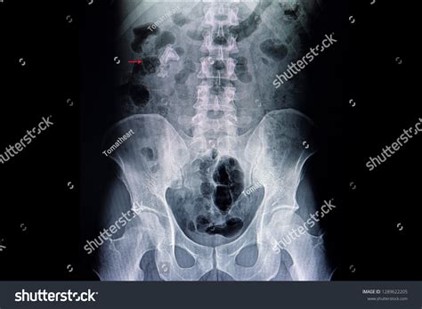 Kidney Ureter Bladder Xray Film Kub Stock Photo 1289622205 Shutterstock