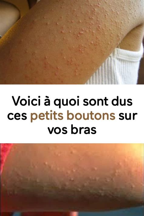 Voici à Quoi Sont Dus Ces Petits Boutons Sur Vos Bras Santé Astuces