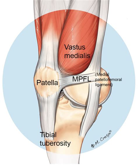 Recurrent Patellar Dislocation Orthosport Victoria